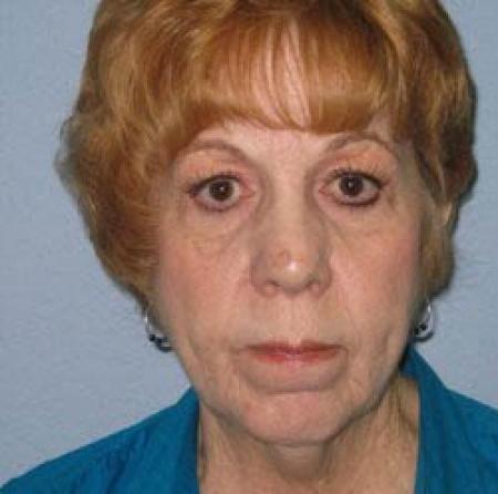 Facelift - Patient 1 - Before Image 3