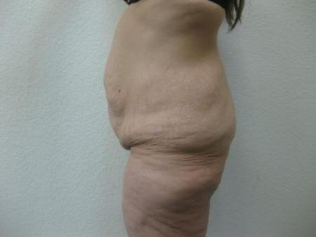 Body Lift - Patient 8 - Before Image 7