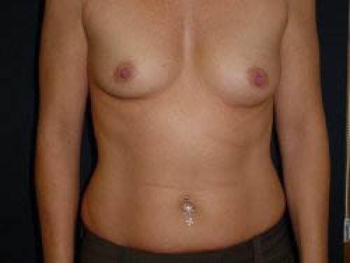 Breast Augmentation - Patient 16 - Before 1