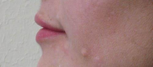 Lip Augmentation - Patient 1 - After 