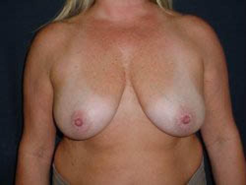 Breast Augmentation with Lift - Patient 6 - Before 1
