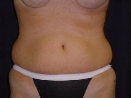 Liposuction - Patient 8 - Before