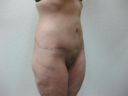 Body Lift - Patient 8 - After Image 1
