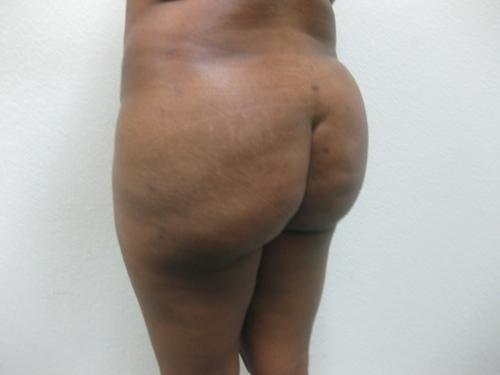 Brazilian Butt Lift - Patient 5 - After 3