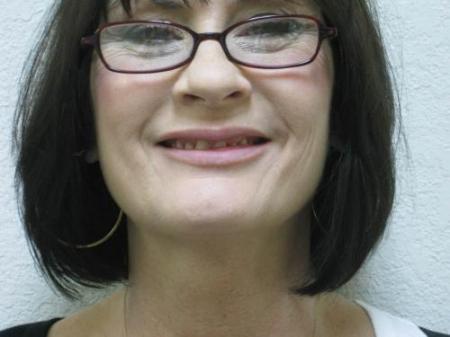 Lip Augmentation - Patient 2 - After Image 6