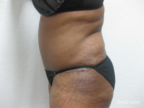 Tummy Tuck - Patient 1 -  After 4