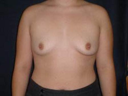 Breast Augmentation - Patient 8 - Before