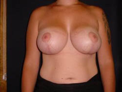 Breast Augmentation with Lift - Patient 5 -  After 1