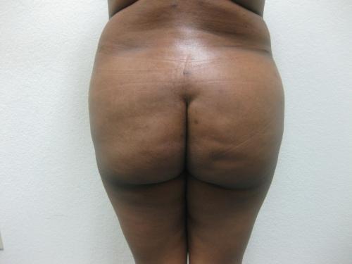Brazilian Butt Lift - Patient 5 - Before