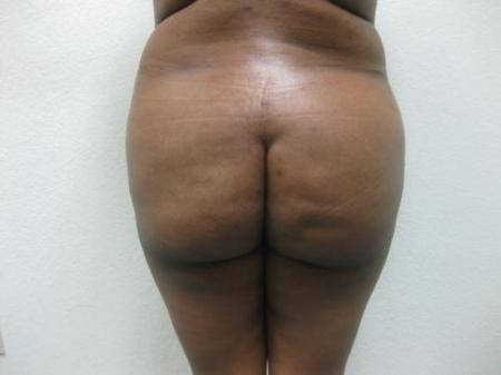 Brazilian Butt Lift - Patient 5 - Before