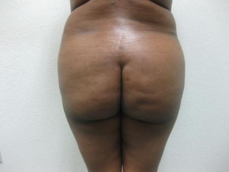 Brazilian Butt Lift - Patient 5 - Before Image 1