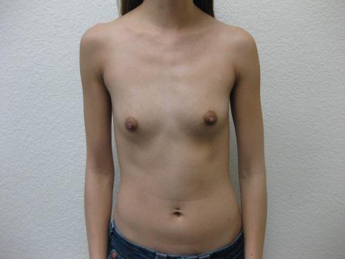 Breast Augmentation - Patient 22 - Before
