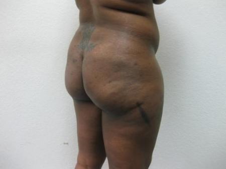 Brazilian Butt Lift - Patient 2 - Before Image 3
