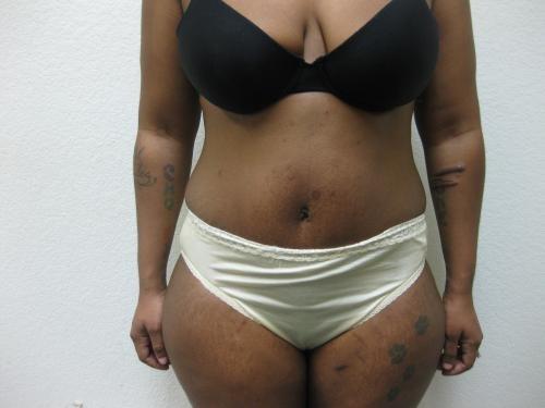 Tummy Tuck - Patient 11 -  After 1