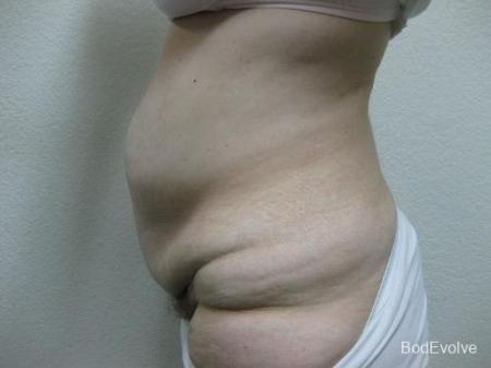 Patient 4 - Cosmetic Surgery After Massive Weight Loss - Before Image 3