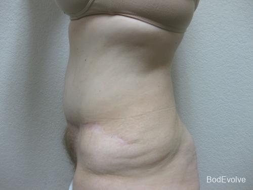 Patient 4 - Cosmetic Surgery After Massive Weight Loss -  After 3