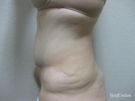 Patient 4 - Cosmetic Surgery After Massive Weight Loss - After Image 3