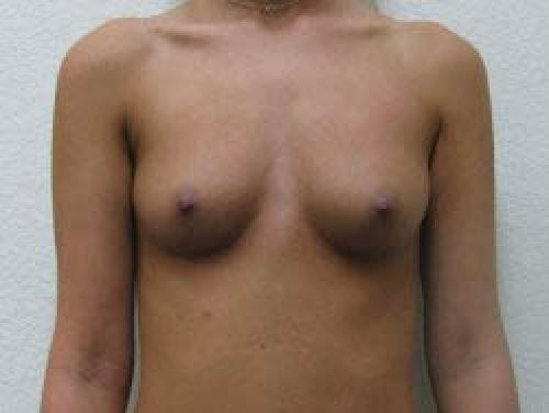 Breast Augmentation - Patient 10 - Before