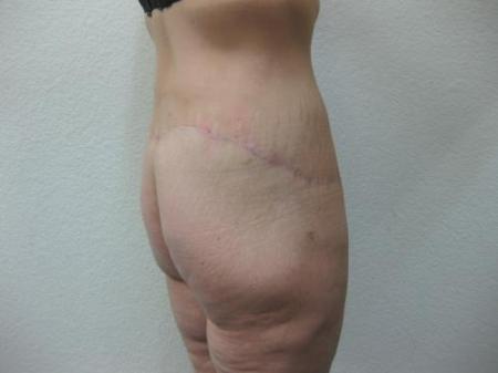 Body Lift - Patient 8 - After Image 4