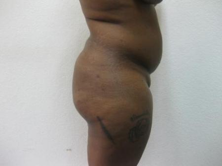 Brazilian Butt Lift - Patient 2 - Before Image 2