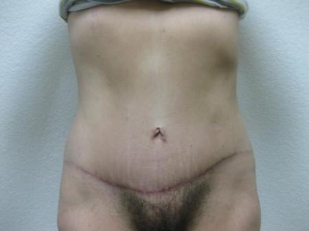 Patient 11 - Cosmetic Surgery After Massive Weight Loss - After 