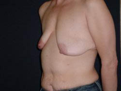 Breast Augmentation with Lift - Patient 7 - Before 2