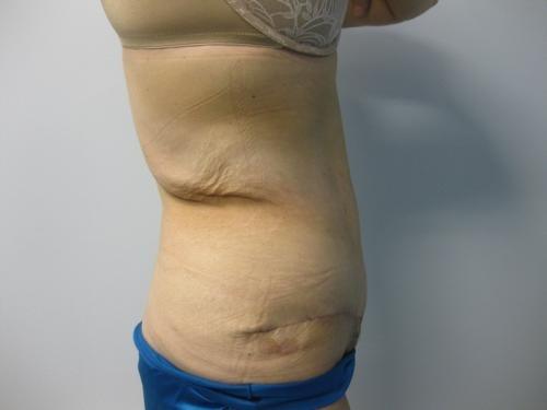 Patient 15 - Cosmetic Surgery After Massive Weight Loss -  After 5