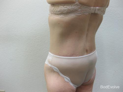 Body Lift - Patient 2 - After 4