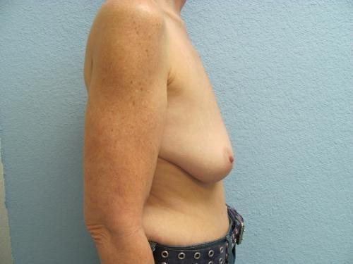 Breast Augmentation with Lift - Patient 10 - Before and After 3