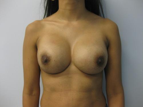 Breast Revision - Patient 2 -  After 1