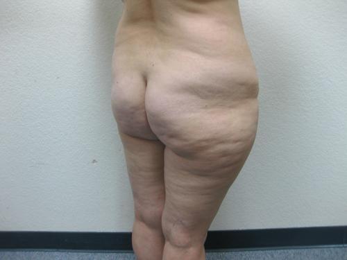 Liposuction - Patient 3 -  After 5