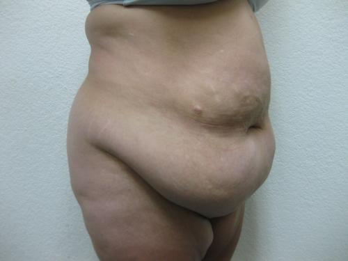 Patient 10 - Cosmetic Surgery After Massive Weight Loss - Before 4