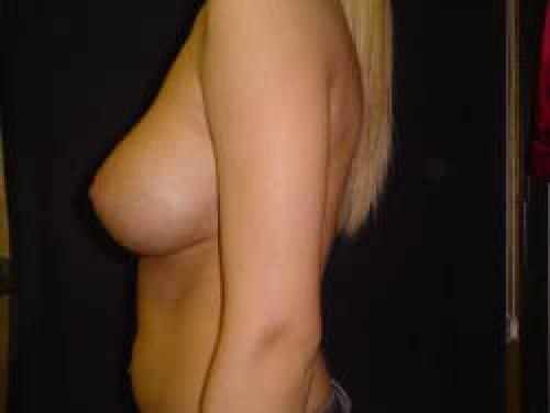 Breast Augmentation - Patient 15 -  After 3