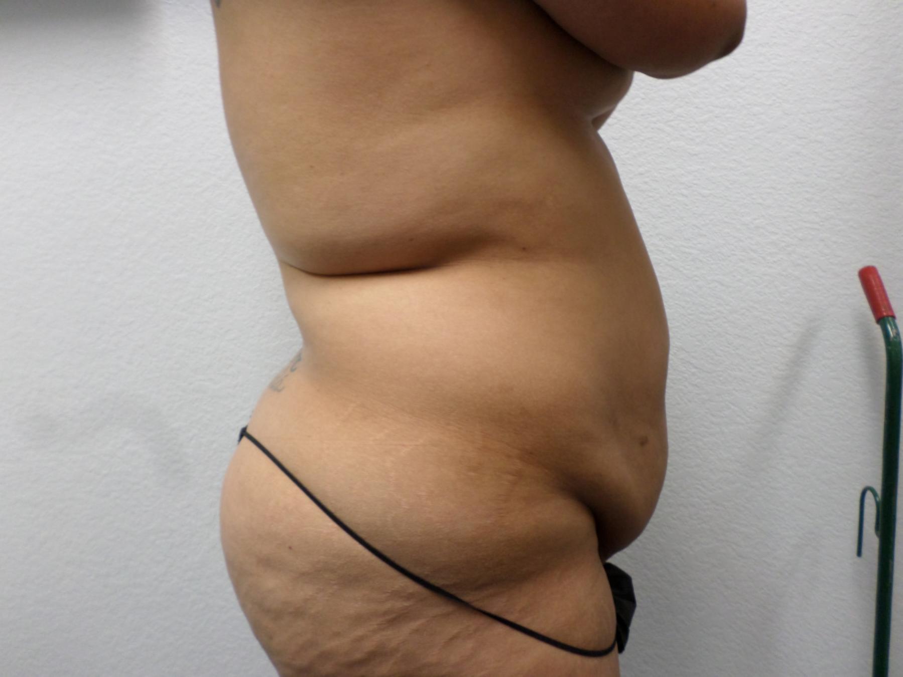Liposuction: Patient 16 - Before and After 5