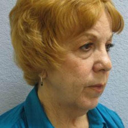 Facelift - Patient 1 - Before Image 4