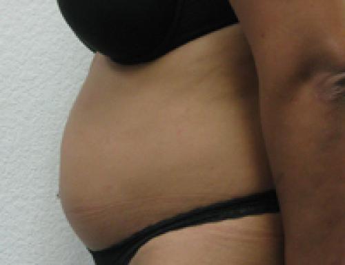 Liposuction - Patient 12 - Before and After 3