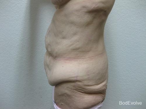 Patient 5 - Cosmetic Surgery After Massive Weight Loss - Before 3
