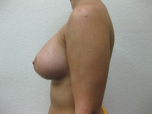 Breast Augmentation - Patient 4 -  After 3