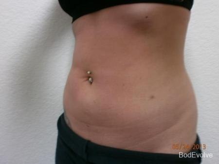 Liposuction - Patient 2 - After Image 2