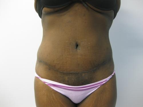 Patient 13 - Cosmetic Surgery After Massive Weight Loss -  After 1