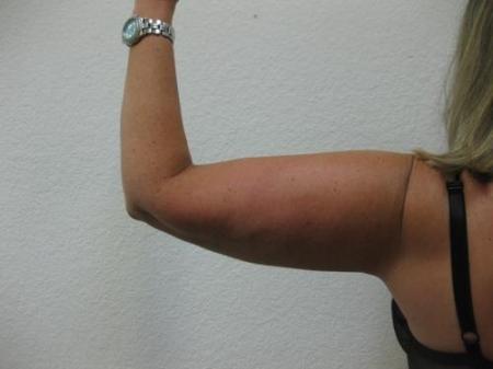 Liposuction - Patient 4 - After Image 3