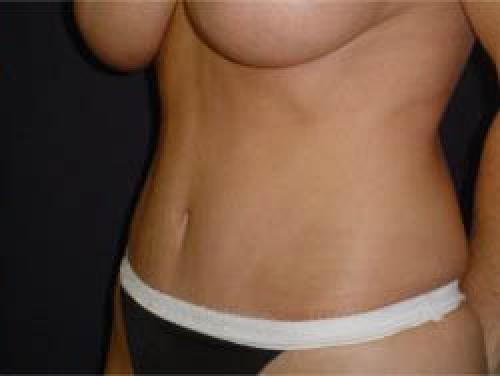 Tummy Tuck - Patient 7 -  After 2