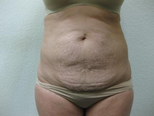 Tummy Tuck - Patient 4 - Before 2