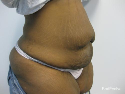 Patient 2 - Cosmetic Surgery After Massive Weight Loss - Before 3