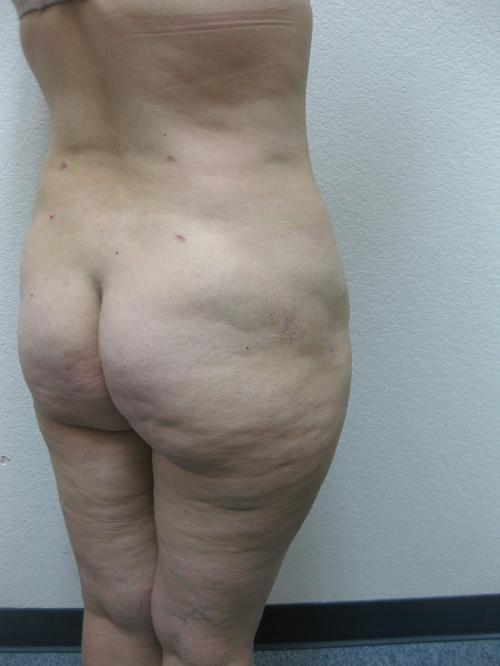 Liposuction - Patient 3 - Before 5