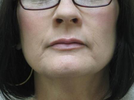 Lip Augmentation - Patient 2 - After Image 7