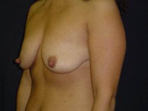 Breast Augmentation with Lift - Patient 3 - Before 2
