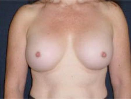 Breast Augmentation - Patient 9 - After 