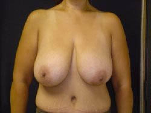 Breast Augmentation with Lift - Patient 9 - Before 1