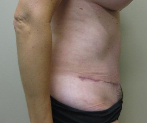 Tummy Tuck - Patient 6 -  After 5